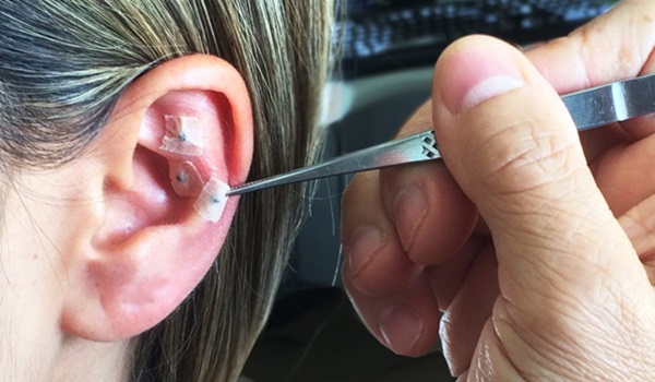 SEAAC Campinas vai oferecer formação em Auriculoterapia em parceria com o Cefac